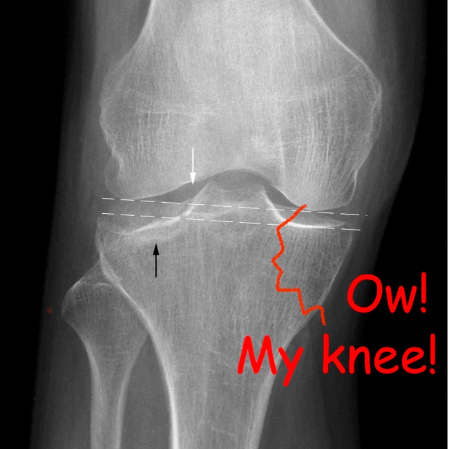 Tibial Plateau Illustration