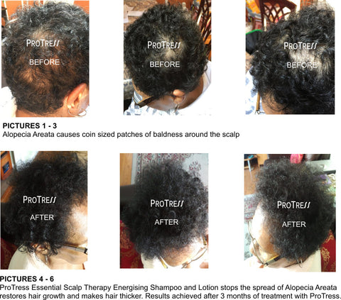 treatment for alopecia areata