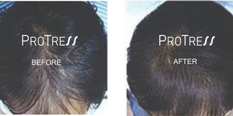 treatment for hair loss caused by extensions