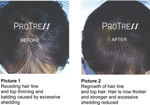 female pattern baldness treatment