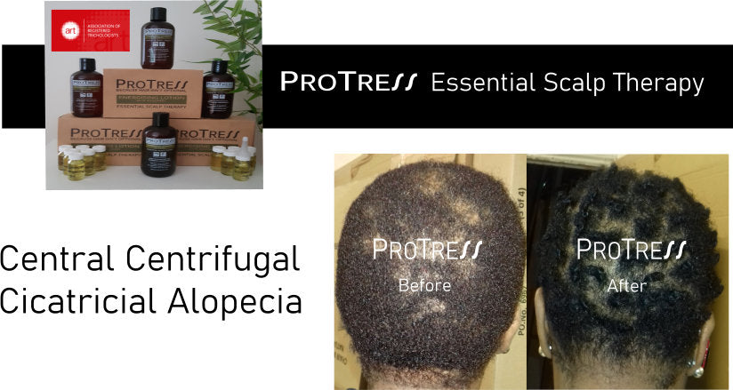 Central centrifugal cicatricial alopecia treatment