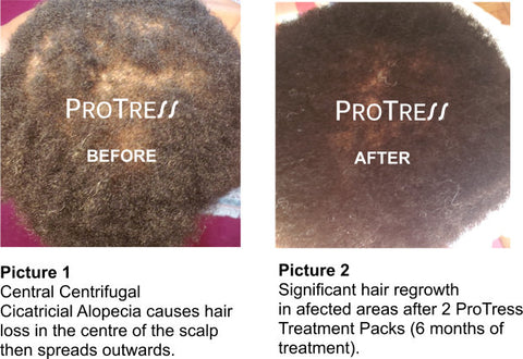 hair loss treatment for black men