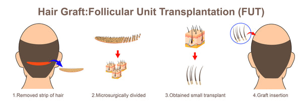Follicular Unit Transplant diagram