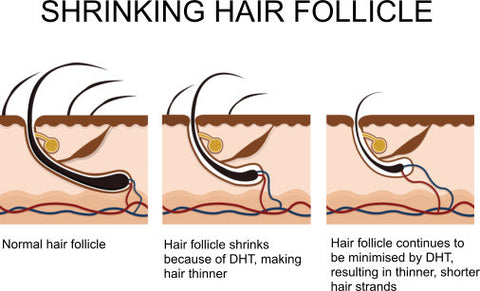 DHT shrinks hair follicles making hair thinner