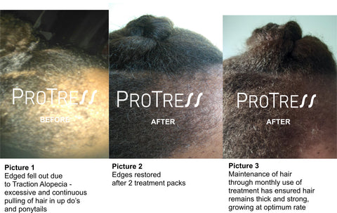 treatment for traction alopecia