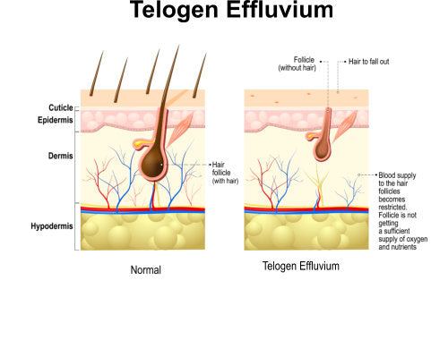 Telogen Effluvium