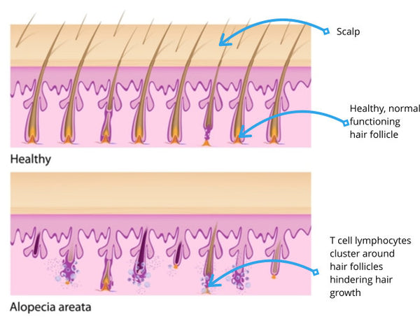 Hair loss is caused through inflammation as T cell lymphocytes (natural killer cells) cluster around affected hair follicles, hindering hair growth.