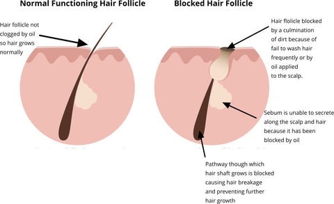 failure to wash textured hair blocks sebaceous gland causing hair loss