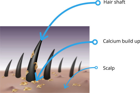 calcium build up on hair and scalp making hair dry and prone to hair breakage and shedding