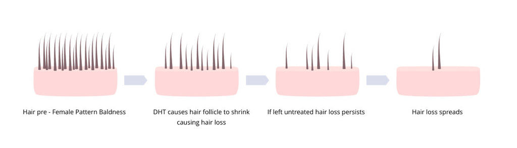 effects of untreated female pattern baldness