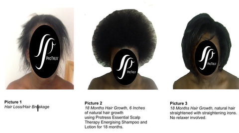 hair loss treatment for afro hair