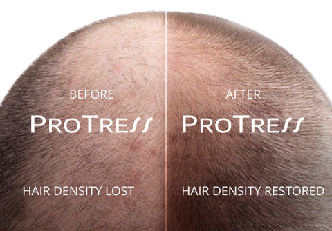 Hair density restored with ProTress