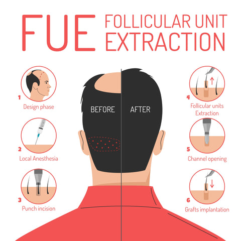 Follicular Unit Extraction diagram
