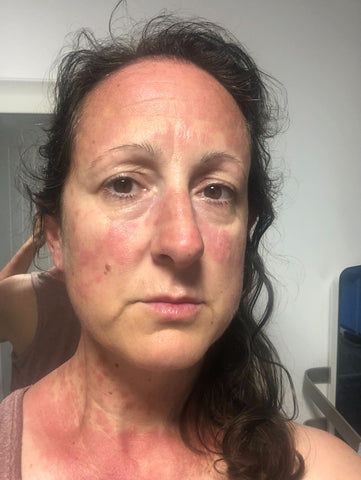 Picture of Tara (Birch & Wilde Founder) very poorly with a nasty lupus butterfly rash or malar and rash on her chest and arms