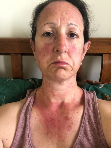 Picture of Tara (Birch & Wilde Founder) very poorly in bed with a nasty lupus butterfly rach and rash on her chest and arms