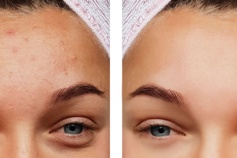 clear complexion before and after pictures showing the improvement with good hydration