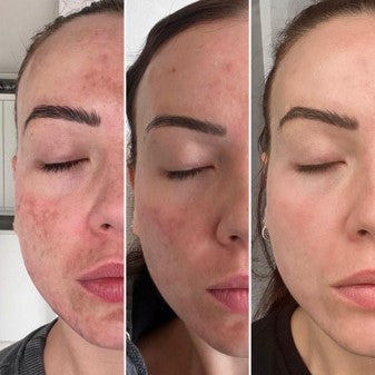 melasma transformation using pca skin ultra peel