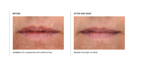 before and after PCA Skin Overnight Lip Mask lip hydration for dry chapped lips