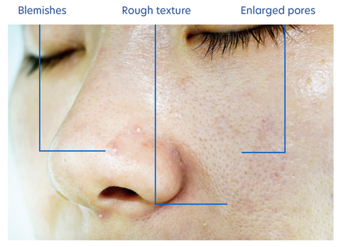 texture image of on oily skin with blemishes