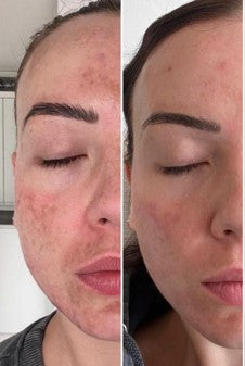 melasma pigmentation before and after one ultra peel treatment