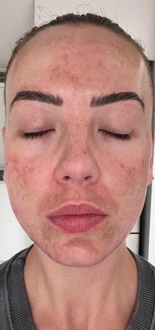 melasma patient pigmentation