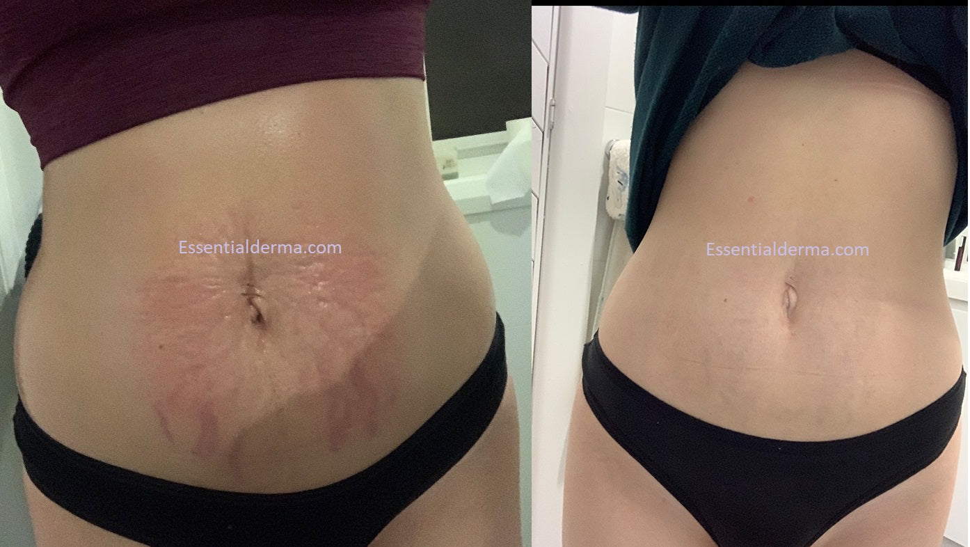 Skin Needling Stretch Marks Results