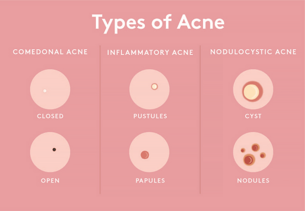 Acne Vs. Pimples: How To Identify & Eliminate Your Zits