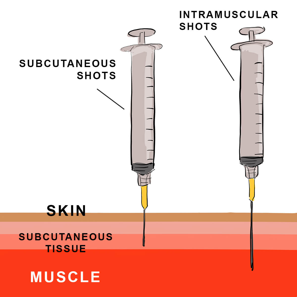 Does size matter when it comes to needles?