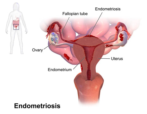 tens machine for endometriosis