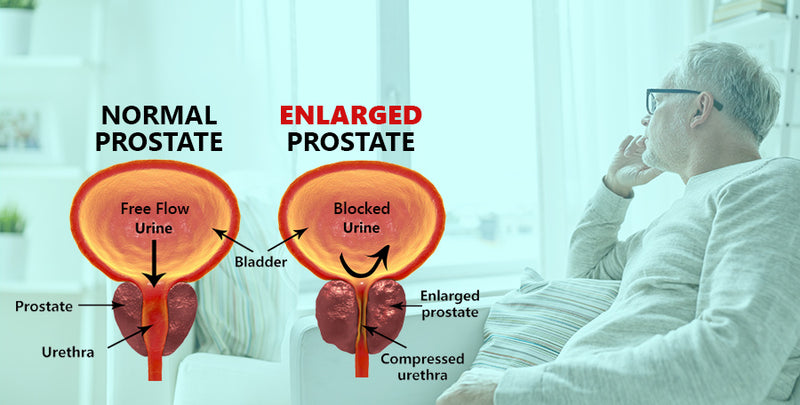 Enlarged Prostate 10 Enlarged Prostate Symptoms Herbal Ignite