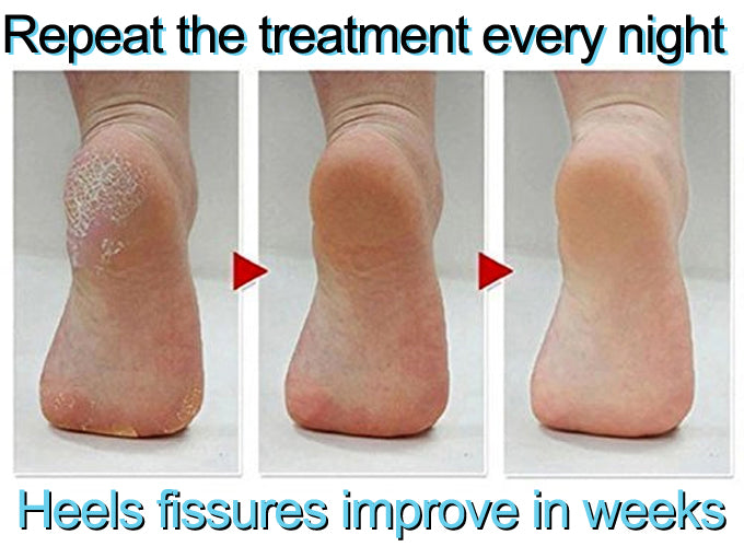 foot fissures treatment