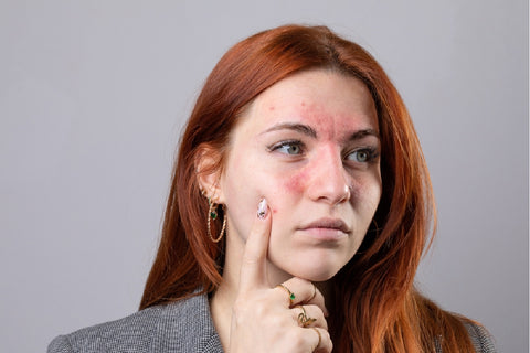 Heal Skin Conditions Such As Eczema