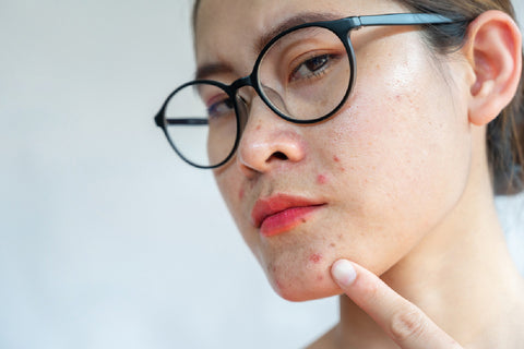 Acne Outbreaks