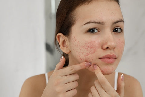 Fights Pimples And Inflammatory Acne