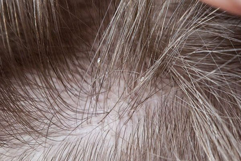 Why Is Argan Oil Good For Lice?