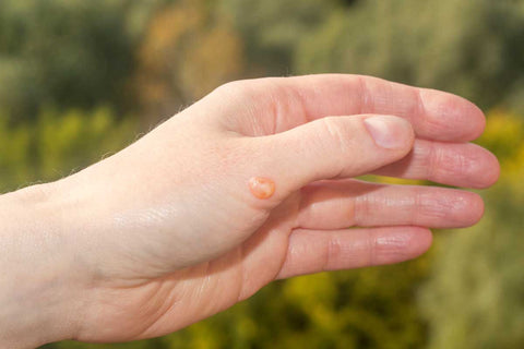 Best Essential Oils For Blisters