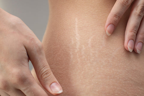 Argan Oil Vs Jojoba Oil For Stretch Marks