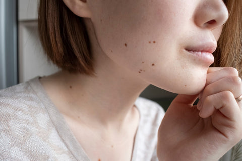 Essential Oils for Moles on Skin