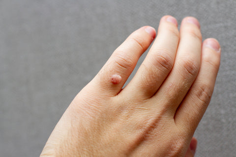 Essential Oils for Warts on Hands