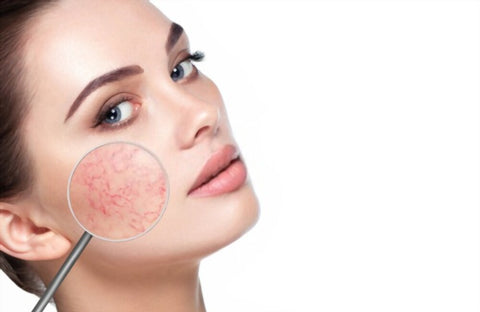 What Is Rosacea And What Causes It?