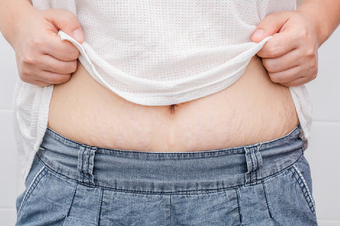 What Are Stretch Marks?