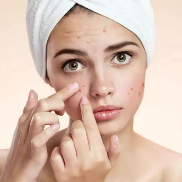 Acne & Pimples Cream & Lotions