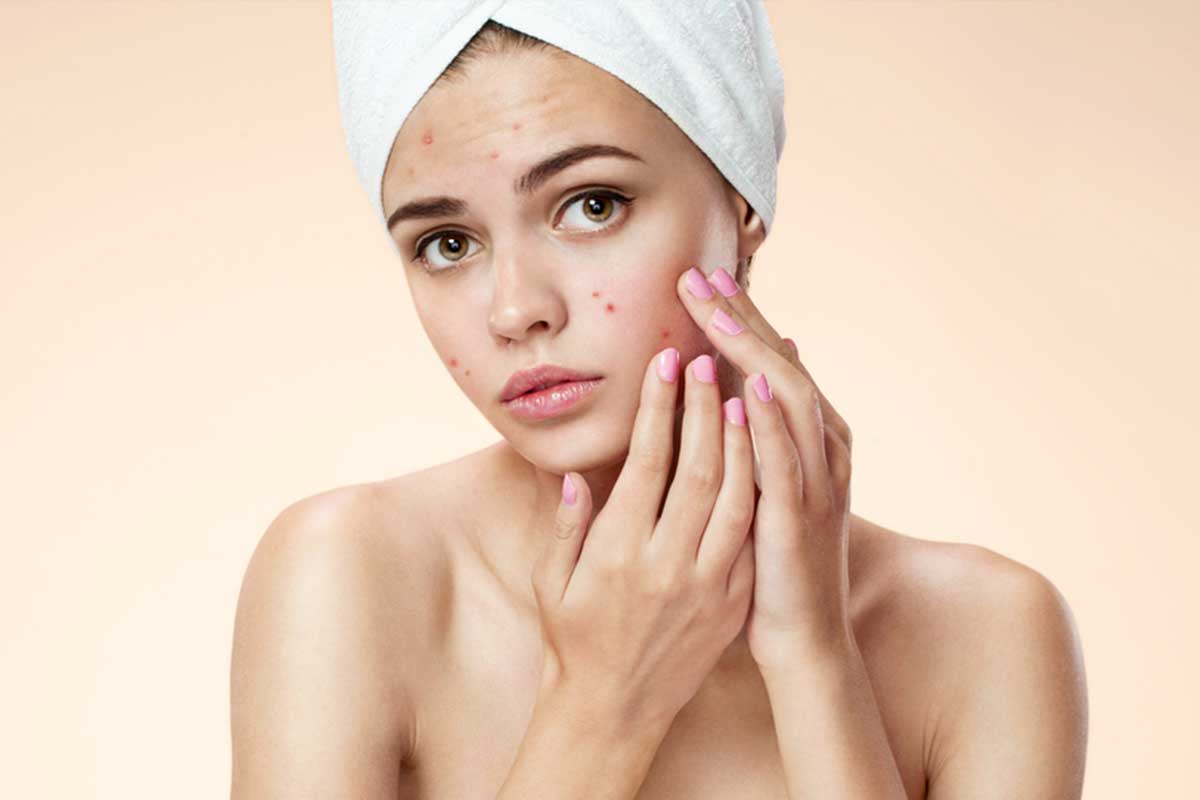 Fights Acne