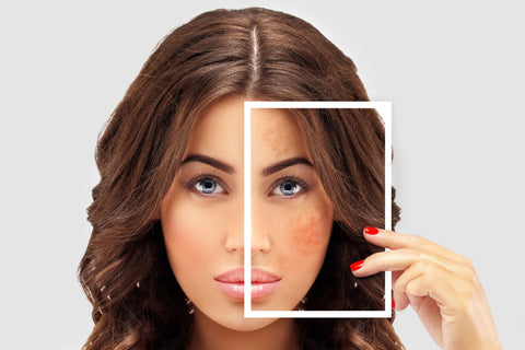 Pigmentation Vs Melasma