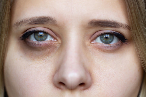 Olive Oil vs Almond Oil for Dark Circles