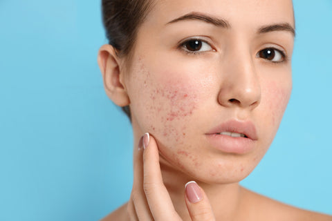 Benefits Of Manjistha Powder For Skin Whitening