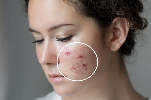 neem oil for acne scars