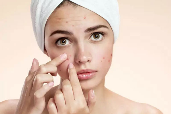 Eliminate Pimples