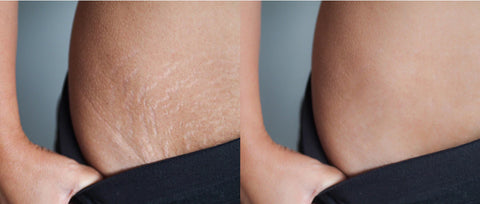 Vitamin E Oil For Stretch Marks Before and After