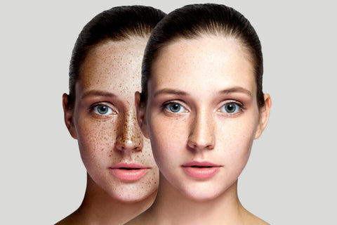 tea tree oil for dark spots on face before after